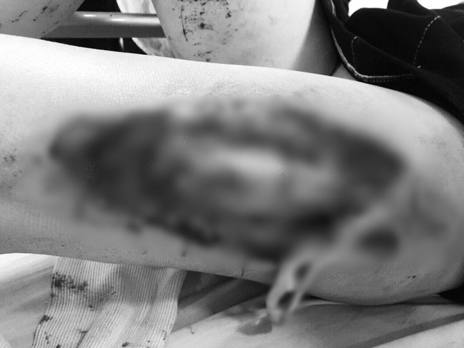 Bác sĩ Bệnh viện Xanh Pôn thông tin vụ nữ CĐV bị pháo bắn trúng: Vết thương do công phá từ sức nổ, không phải do bỏng - Ảnh 3.