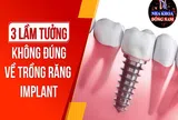 Những suy nghĩ sai lầm về cấy ghép răng Implant