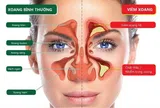 Các loại viêm xoang thường gặp và triệu chứng