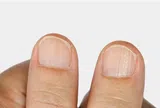 Màu sắc khác thường ở móng tay, chân biểu hiện bệnh gì?
