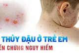Cứu sống bé sơ sinh 15 ngày tuổi bị thủy đậu biến chứng ác tính