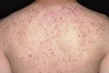 Viêm Nang Lông: Nguyên Nhân, Triệu Chứng & Cách Điều Trị Hiệu Quả