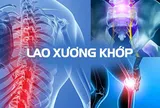 Ai là người dễ bị lao xương khớp?