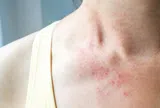 Bảo Thanh Đường - nơi chữa bệnh chàm tận gốc.