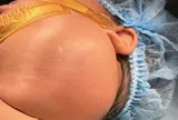 Các biến chứng của u nang bạch huyết ở trẻ em