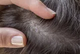 Bảo Thanh Đường - Điều trị dứt điểm bệnh viêm chân tóc