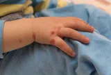 Cẩn thận với biến chứng của bệnh tay chân miệng ở trẻ em!