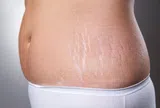 Bất ngờ: Điều trị vết rạn da đỏ nhanh nhất bằng công nghệ hiện đại 
