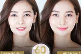 Giải mã: "Làm đầy má hóp thái dương lõm cách nào tốt nhất"
