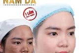 Thẩm mỹ viện rose điều trị nám hiệu quả an toàn nhất hà nội