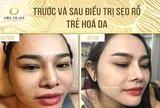 Lưu ý chăm sóc da đúng cách sau liệu trình laser