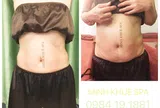 Phương pháp giảm mỡ bụng nhanh chóng, hiệu quả, đảm bảo mỡ thừa không quay lại