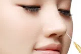 Tiêm filler nhân trung và lời cảnh tỉnh cho các chị em
