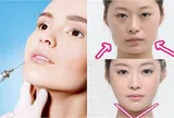 Tiêm filler nhỏ mặt – ưu điểm hay những biến chứng không lường trước?