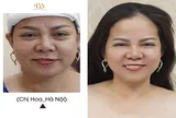 Off 50% công nghệ Ultherapy: Nâng cơ mặt - Da săn chắc - Không cần phẫu thuật
