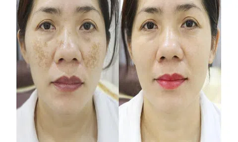 Thẩm mỹ viện quốc tế Bắc Âu điều trị sạch nám sáng da 1 lần