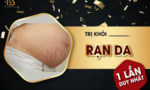 Điều trị rạn da tại Thẩm mỹ viện quốc tế Bắc Âu uy tín tại Hà Nội