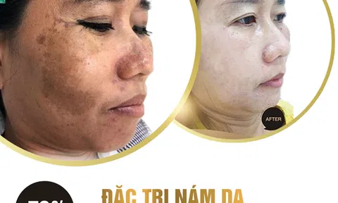 Thẩm mỹ viện Rose điều trị nám uy tín hiệu quả tại Hà Nội