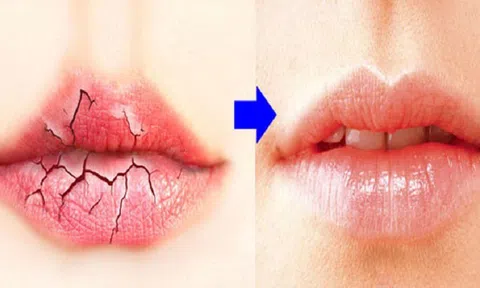 8 cách đánh bay đôi môi nứt nẻ mùa đông cực kì hiệu quả