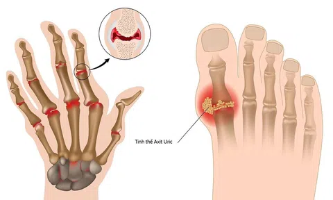 Chuyên gia giải mã tác dụng của nước điện giải ion kiềm trong phòng trừ gout