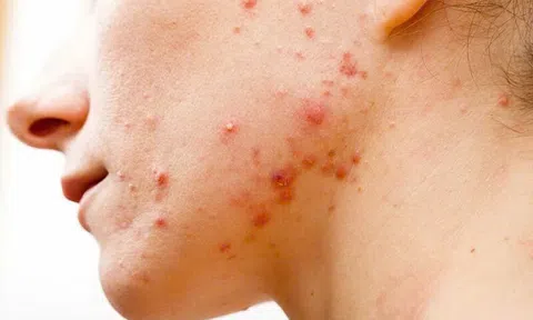 Cùng đi tìm nơi chữa viêm nang lông hiệu quả nhất...