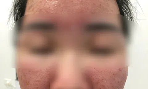 Nữ sinh Hà Nội "cháy da" vì tin lời quảng cáo kem chống nắng giá rẻ trên mạng