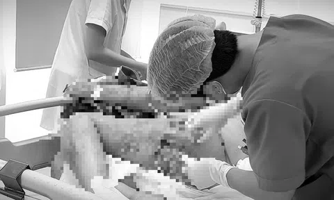 Nguy kịch sau khi tự trích mụn nhọt tại nhà