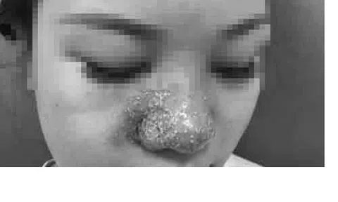 Hôm trước tiêm filler, hôm sau cầu cứu bác sĩ vì mũi đỏ như cà chua, chi chít mụn