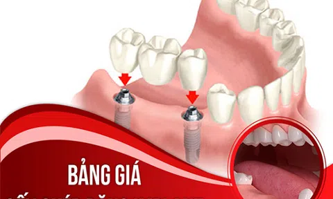 Bảng giá cấy ghép răng Implant tại Nha Khoa Đông Nam