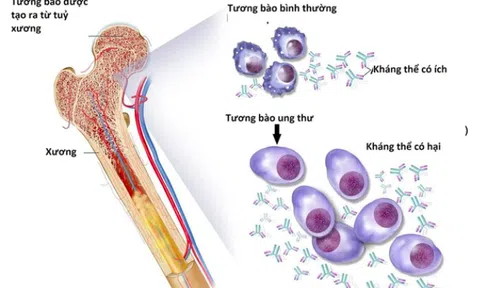 5 câu hỏi thường gặp với bệnh đa u tủy xương