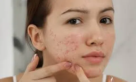 Da mụn và cách chăm sóc trong mùa đông