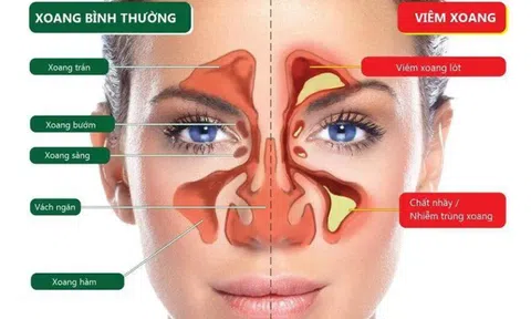 Các loại viêm xoang thường gặp và triệu chứng