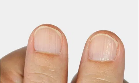 Màu sắc khác thường ở móng tay, chân biểu hiện bệnh gì?
