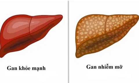 4 dấu hiệu cảnh báo mắc bệnh gan nhiễm mỡ dễ nhận biết