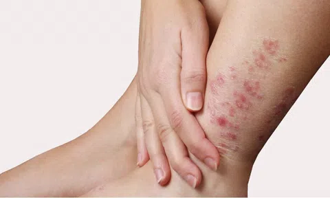 Bảo Thanh Đường - Địa chỉ uy tín chữa tận gốc bệnh chàm - eczema