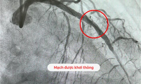 Cứu sống cụ ông 76 tuổi nhồi máu cơ tim, sốc tim, hẹp nặng 3 nhánh mạch vành