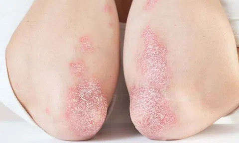 Bệnh vảy nến có lây không? Chuyên gia giải đáp chi tiết!