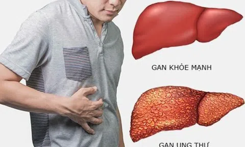 Sỏi túi mật hình thành do đâu? Cách giảm nguy cơ hiệu quả, an toàn