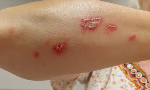 Mùa hè cảnh giác với bệnh da do côn trùng