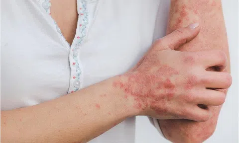 Điều trị sớm bệnh vẩy nến tránh nguy cơ biến chứng