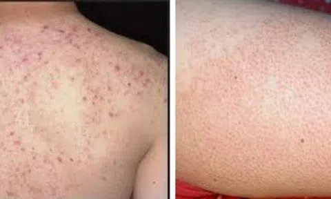 Bệnh viêm nang lông và cách điều trị