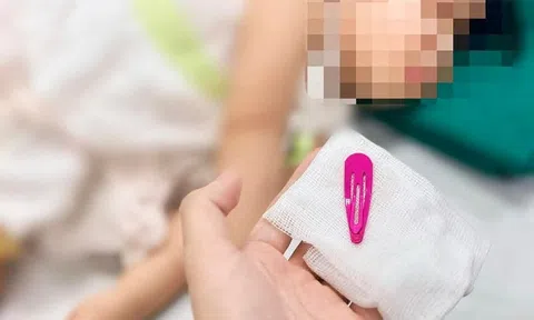Bé gái 21 tháng tuổi nuốt kẹp tóc vào dạ dày, bác sĩ cảnh báo những thói quen nguy hiểm