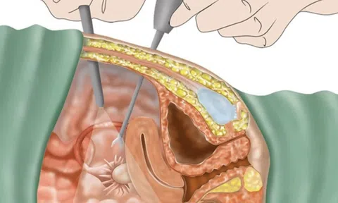 Nguy cơ mang thai ngoài tử cung, vô sinh từ căn bệnh phụ khoa ít triệu chứng