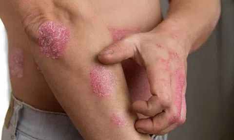 CÁCH CHỮA BỆNH VẢY NẾN LÂU NĂM