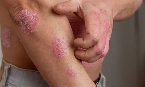 Chữa bệnh chàm á sừng bằng phương thuốc quý tại Bảo Thanh Đường
