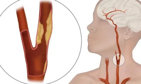 Hẹp động mạch cảnh có cần phẫu thuật không?
