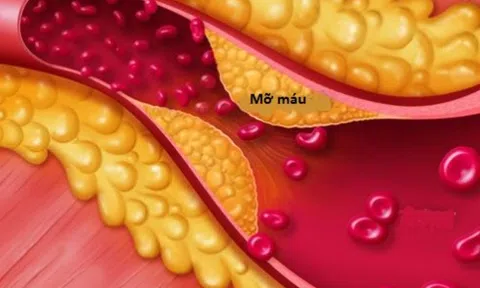 Mỡ máu cao không được chủ quan, kể cả người gầy