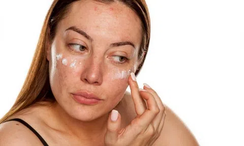 Vì sao nám da dễ tái phát sau khi đã điều trị thành công?