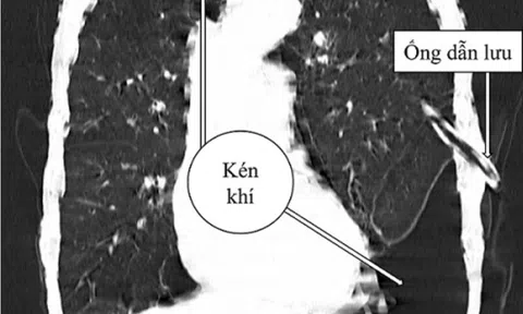 Đột ngột khó thở cảnh giác với kén khí phổi