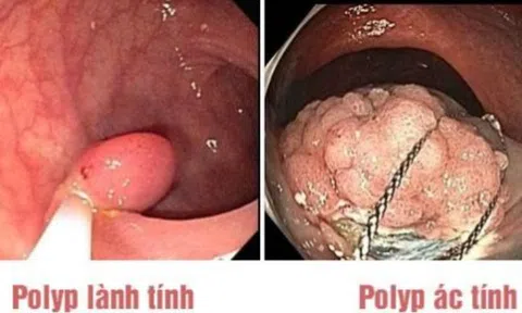 Polyp đại tràng có nguy hiểm không?